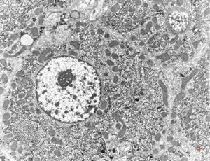 M,19y. | normal hepatocyte M,19y. | normal hepatocyte